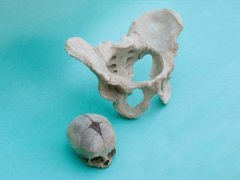 신생아의 두개골은 태어날 때 여성의 골반을 통과해야 한다 - 산도의 지름보다도 크면 곤란하다. Credit: Copyright Magdalena Fischer