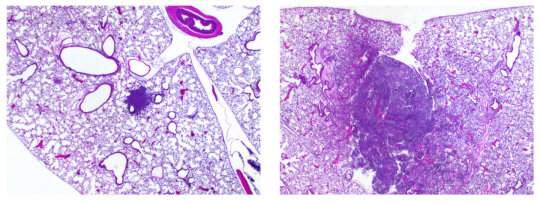 폐조직 사진에서 볼 수 있는 염증 병변. 왼쪽은 Pla 유전자가 없는 오래된 폐 페스트 박테리아 스트레인으로 인한 것, 오른쪽은 Pla 유전자가 있는 박테리아로 인한 것. Pla 유전자가 이 스트레인에 추가되면서 폐페스트를 일으키게 되었다. Credit: Image courtesy of Northwestern University