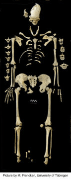 약 7천 년 된 여성의 골격에서 백혈병의 흔적이 발견되었다. Credit: ⓒ M. Francken/Universitat Tubingen